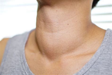 Enfermedades de la tiroides, ¿cómo detectarlas a tiempo? | Salud180