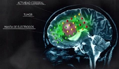 Enfermedades del cerebro: Síntomas, tipos, tratamientos y ...