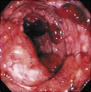 Enfermedades del Sistema Digestivo: Colitis