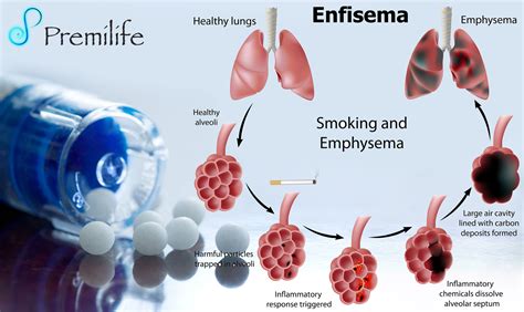 Enfisema   Premilife   Homeopathic Remedies