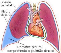 Enfisema pulmonar | DICAS PARA A CURA