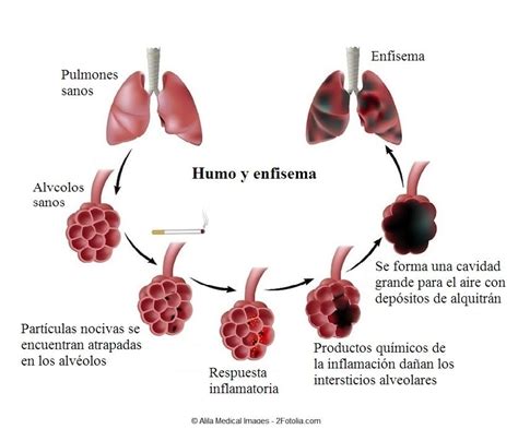 Enfisema pulmonar   tratamiento y remedios naturales ...