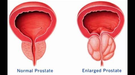 Enlarged Prostate   Causes And Symptoms Of Enlarged ...