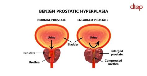 Enlarged Prostate   What you need to know | Dr Tan & Partners