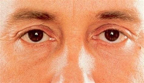 Enucleación Ocular en Casos de Tumores