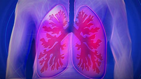 EPOC  Enfermedad Pulmonar Obstructiva Crónica : Condición ...
