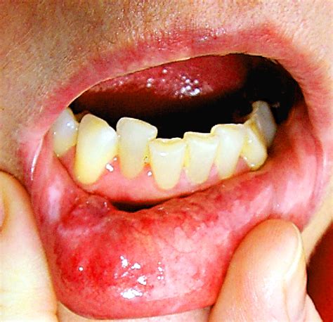 Erosive Oral Lichen Planus: Lower Lip Blisters   Oral ...