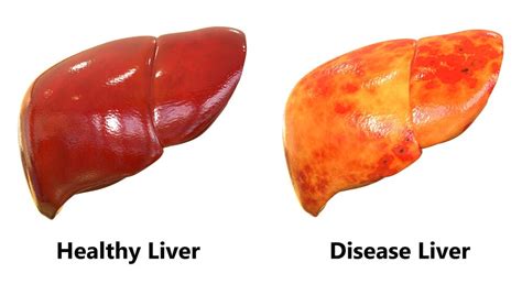 ¿Es posible depurar el hígado naturalmente? — Mejor con Salud