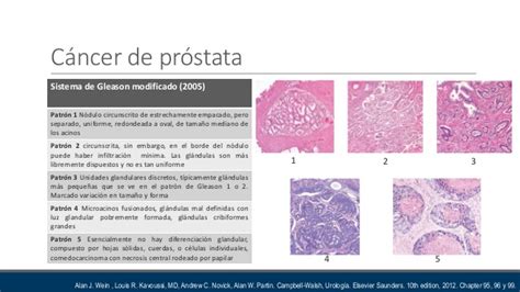 ESCALA DE GLEASON CANCER DE PROSTATA PDF