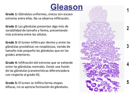 ESCALA GLEASON CANCER PROSTATA PDF