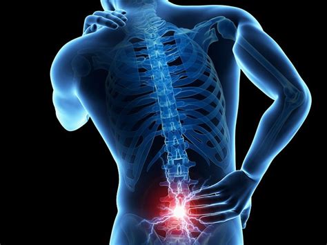 Espondilolistesis: cuando el dolor de espalda afecta la ...