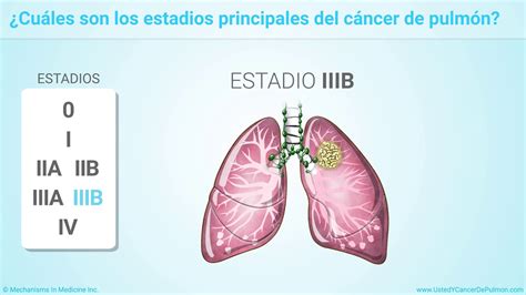 Estadificación del cáncer de pulmón   YouTube