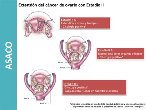 Estadios cáncer de ovario