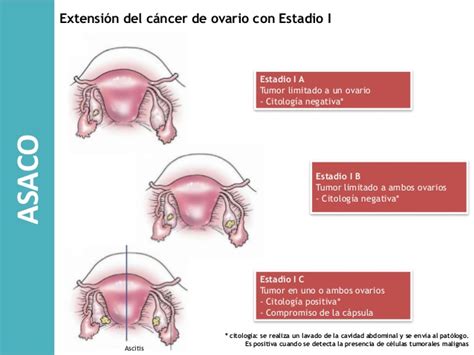 Estadios cáncer de ovario