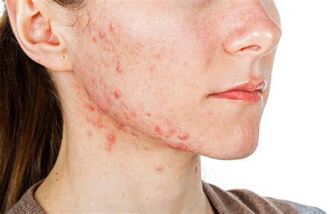 Estas son las 9 enfermedades más comunes de la piel | La Opinión