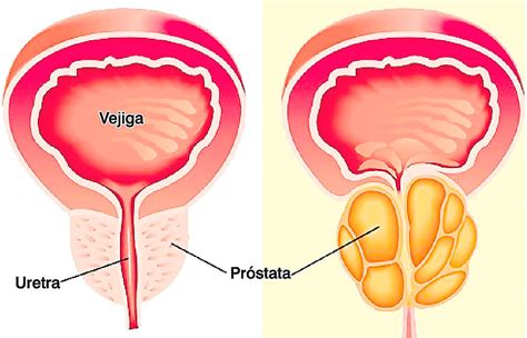 Estas son las señales de alerta del cáncer de próstata ...