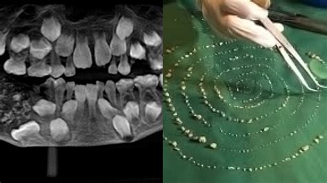 Este niño tenía más de 500 dientes en un tumor dentro de la boca