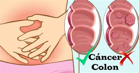 Esto es lo que necesitas saber sobre el cáncer de colon ...
