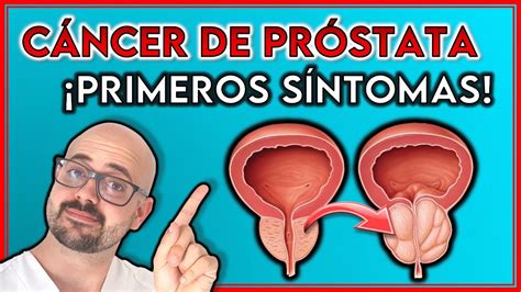 ESTOS son los 7 PRIMEROS SÍNTOMAS del CÁNCER DE PRÓSTATA ||¡SEÑALES que ...