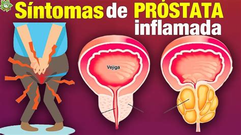 Estos Son Los Síntomas de la Próstata Inflamada y Nunca ...