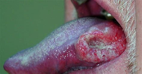 Estudo associa HPV a câncer de boca e garganta.