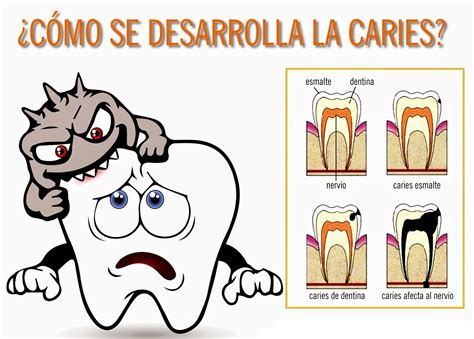 Etapas de la Caries Dental   Dentista Jaén | Espacio Dental Jaén