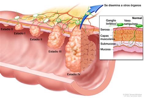 ETAPAS DEL CANCER DE COLON | Sigmoidoscopia s Blog
