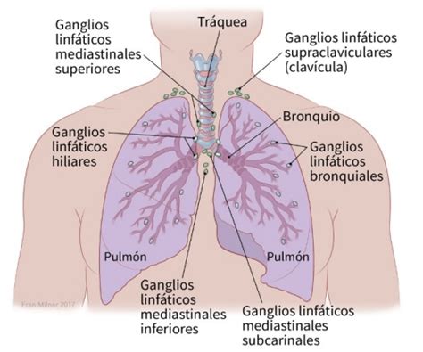 Etapas del cáncer de pulmón no microcítico