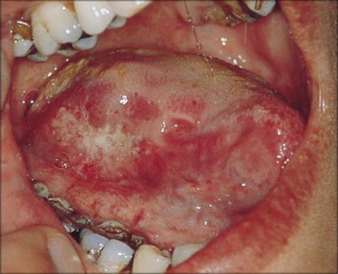 Ethnicity and oral cancer   The Lancet Oncology