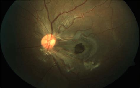 Evaluation of Retinal Pigment Epithelial Hamartoma Using Oct – A Case ...
