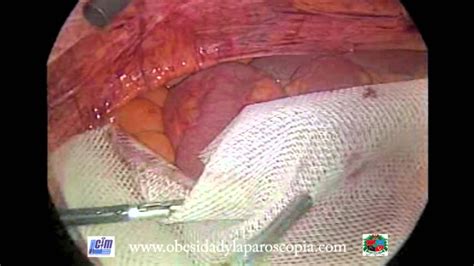 Eventroplastia abdominal con malla por laparoscopia   YouTube