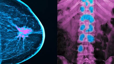 Everything You Need to Know About Breast Cancer Metastasis ...
