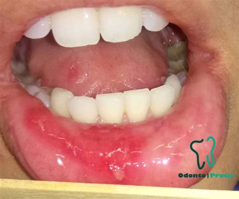 exame clínico em lesões em tecidos moles da boca ...