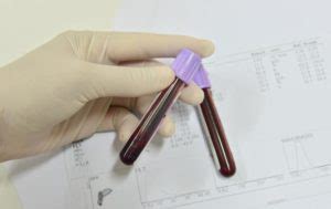 Examen Linfocitos   recuento de CD3, CD4 y CD8 en Santa Marta