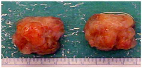 Example of explanted teratomas. Following explantation, the teratoma ...