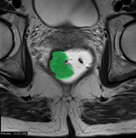 Example of tumor volumetry. Rectal MRI of a villous tumor ...