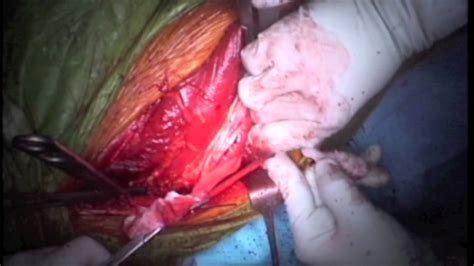 Excision of a Malignant Tumour of the Proximal Femur   YouTube