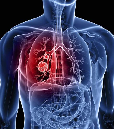 Éxito de la primera fase de un ensayo para cáncer de pulmón