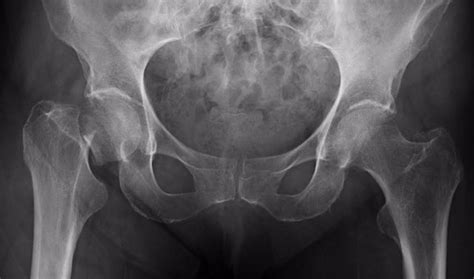 Expertos recomiendan el tratamiento para la osteoporosis ...