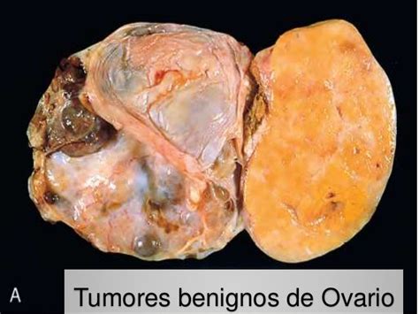 Expo tumores beningnos de ovario jimr