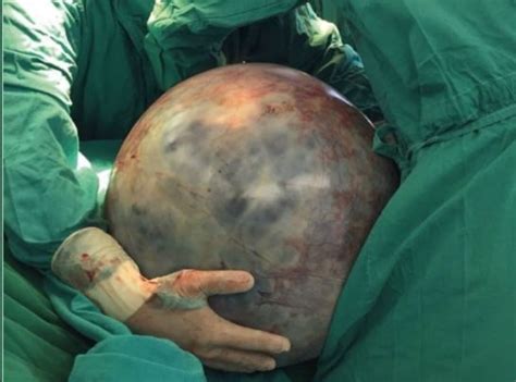 Extirpan a una costarricense el tumor más grande del mundo