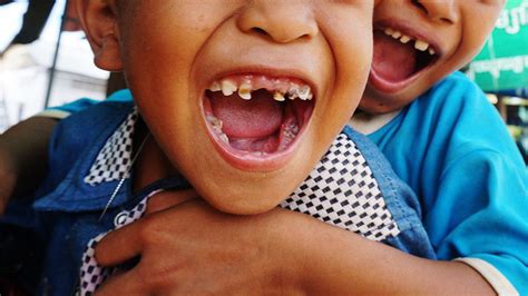 Extraen más de 500 dientes a un niño indio de 7 años ...