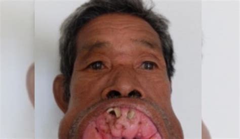 Extraño tumor deformó toda su boca. Lo operaron de urgencia y mostró un ...