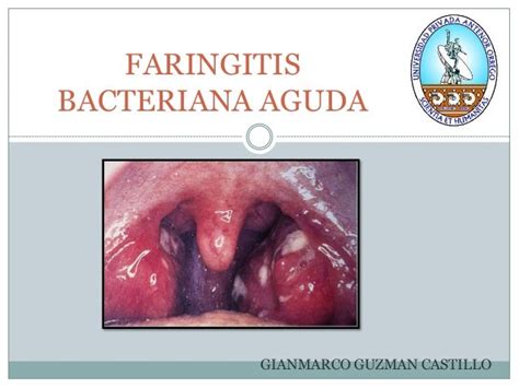 Faringitis bacteriana aguda y otitis media aguda ...