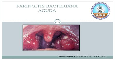 Faringitis bacteriana aguda y otitis media aguda ...