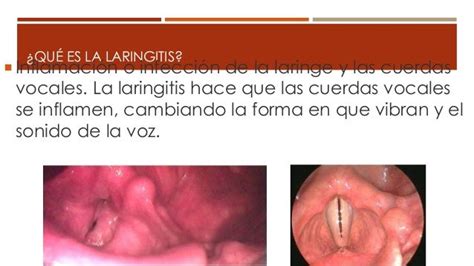 Faringitis