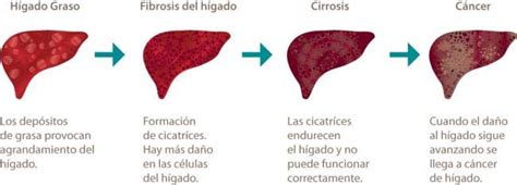 Fases de la Cirrosis
