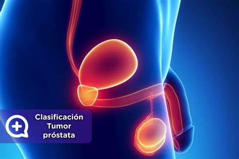 Fases del tumor de próstata   mediQuo