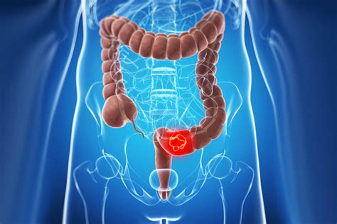 FDA nod to Exact Sciences’ Cologuard test for colon cancer