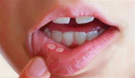Feridas na boca: sintomas, causas e tratamentos.   Clínica ...